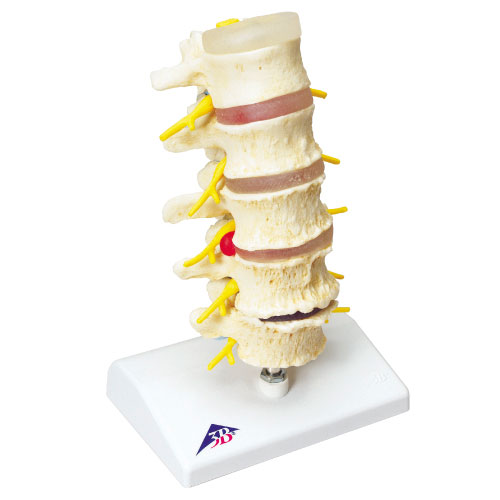 椎間板ヘルニアと変形性脊椎症モデル A795 ﾂｲｶﾝﾊﾞﾝﾍﾙﾆｱﾄｾｷﾂｲｼｮｳﾓ(11-2825-00)【京都科学】[1台単位]