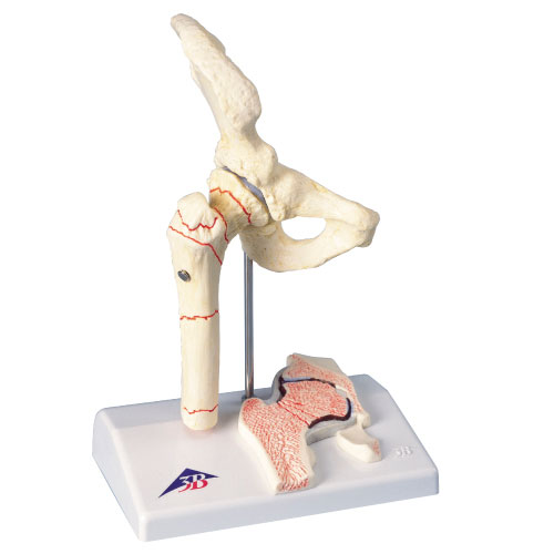 大腿骨骨折解説模型（１／２） A88 ﾀﾞｲﾀｲｺﾂｺｯｾﾂｶｲｾﾂﾓｹｲ(11-2830-00)【京都科学】[1台単位]