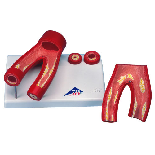 動脈硬化症モデル（断面レリーフ付） ﾄﾞｳﾐｬｸｺｳｶｼｮｳﾓﾃﾞﾙ G40【1台単位】(23-7760-00)